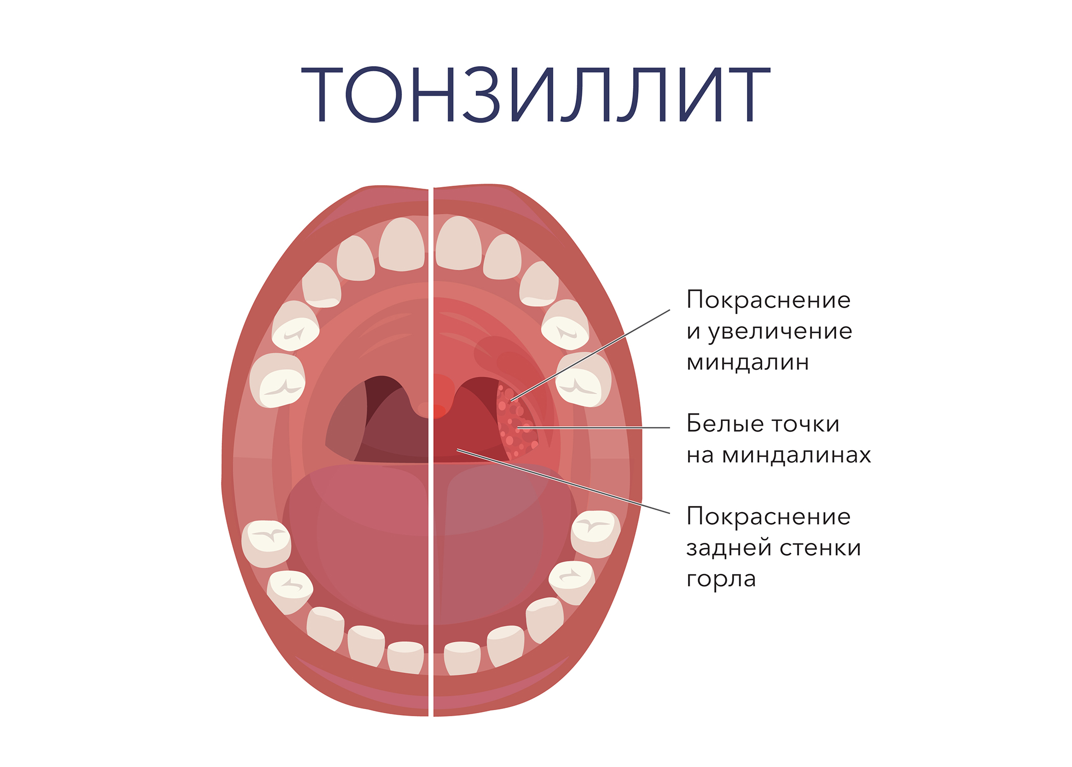 Диета При Хроническом Тонзиллите