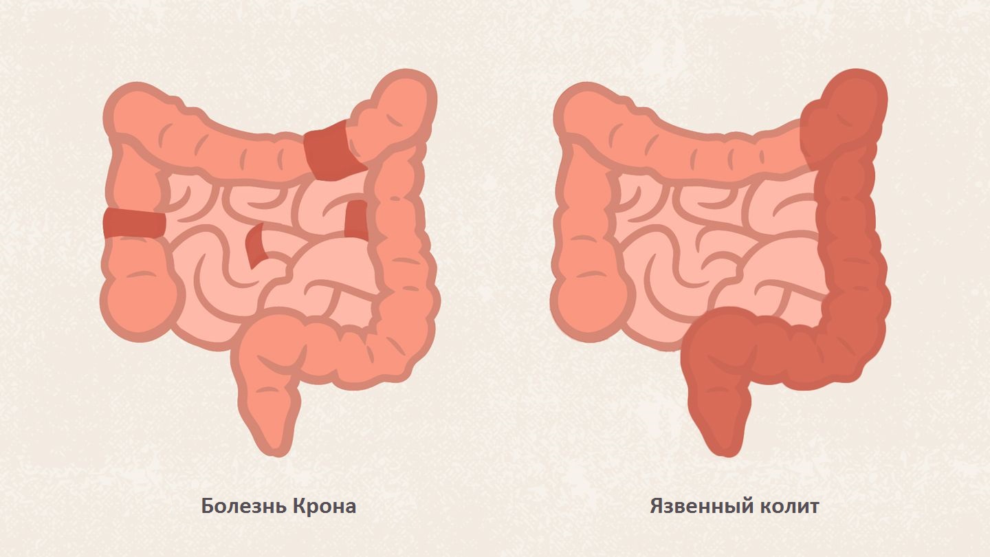 Приступ колита. Язвенный колит и болезнь крона. Язвенный колит булыжная Мостовая.