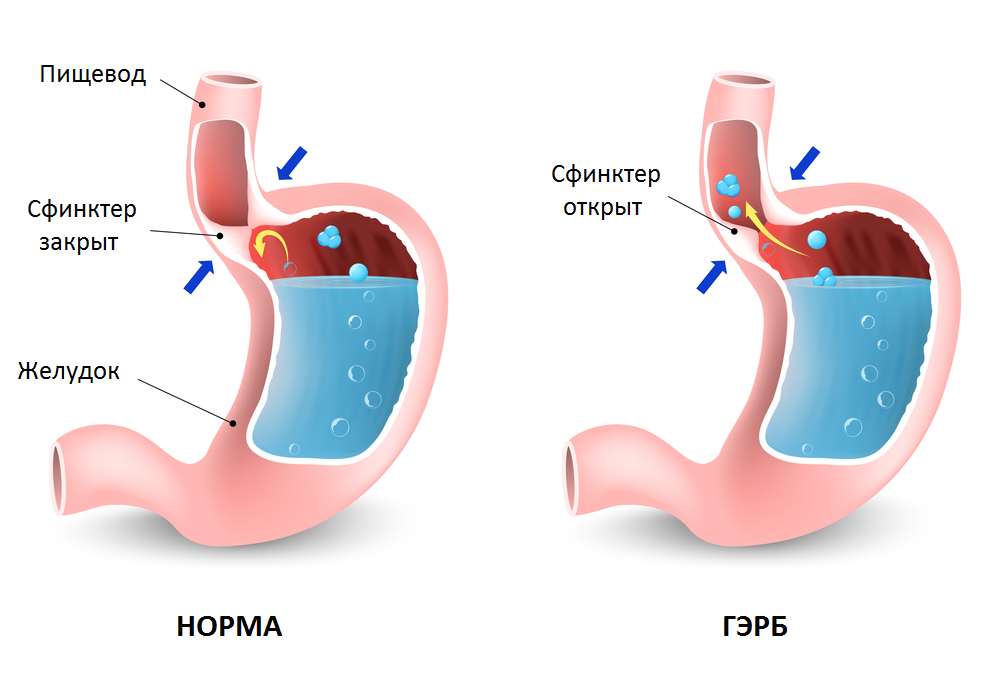 Гастроэзофагеальная рефлюксная болезнь (ГЭРБ)