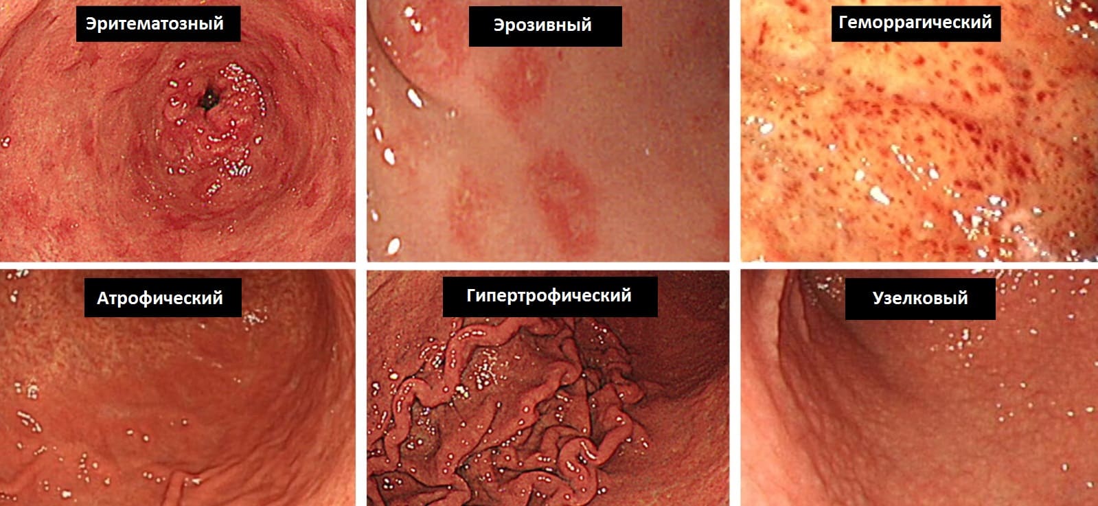 Эндоскопическая классификация гастрита
