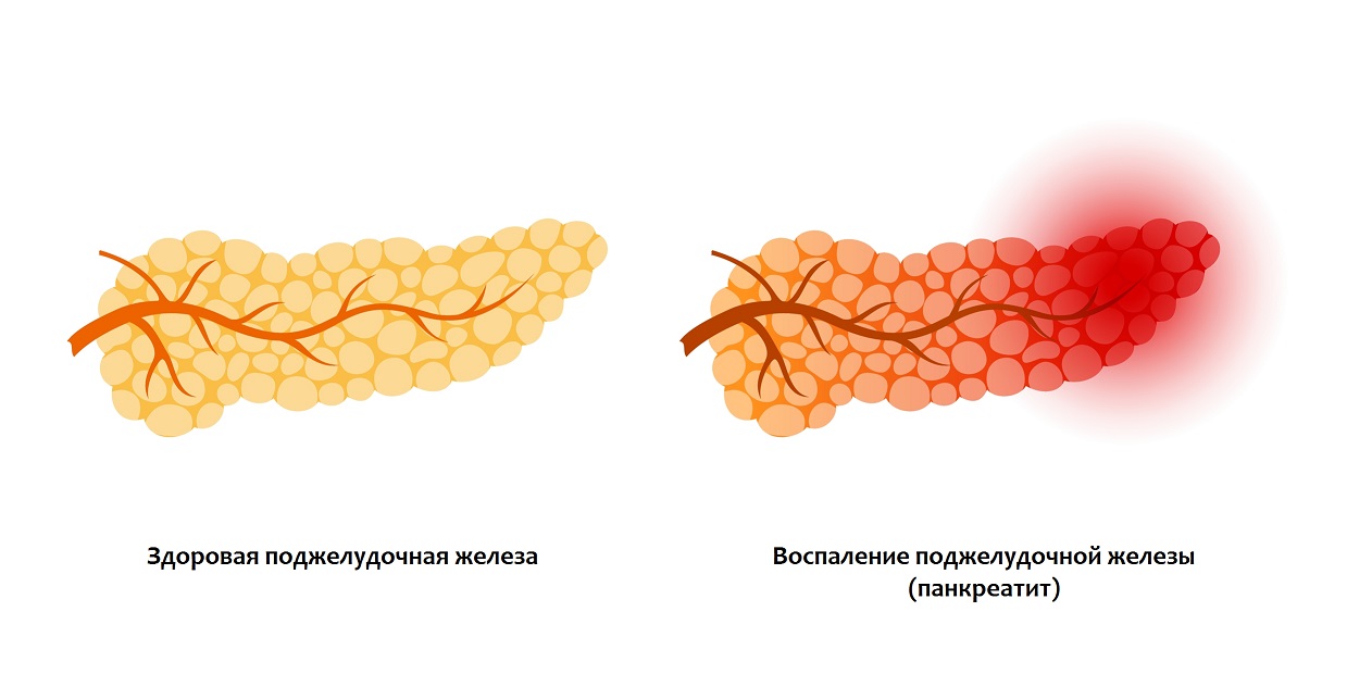 Панкреатит